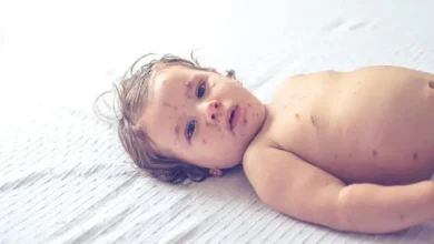 Casos de sarampo disparam 34 vezes em 2025, alerta Opas